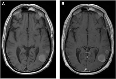 A radiation oncology approach to brain metastases